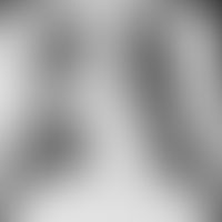 Aspergillosis: X-ray of the lungs
