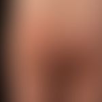 Ilven: acquired, inflammatory, Blaschko-linear dermatosis in a 10-year-old girl; healing after on...