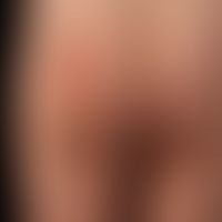 Ilven: acquired, inflammatory, Blaschko-linear dermatosis in a 10-year-old girl; healing after on...