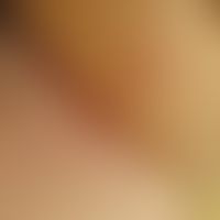 Candidosis intertriginous: 22-year-old slightly obese woman with signs of an atopic dermatitis (n...