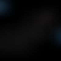 Estron: Structural formula of estrone (oestrone)
