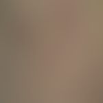 Taxane induced multiform exanthema
