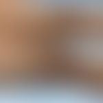 Haemochromatosis: small and large patches of hyperpigmentation on both lower extremities, flat ov...