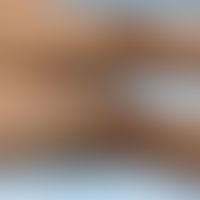 Haemochromatosis: small and large patches of hyperpigmentation on both lower extremities, flat ov...
