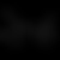 Pilocarpin: Strukturfromel von Pilocarpin (Imidazolalkaloid)
