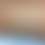 Hemochromatosis: discrete spotty and streaky, symptomless hyperpigmentation on both lower extremi...