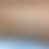 Hemochromatosis: discrete spotty and streaky, symptomless hyperpigmentation on both lower extremi...