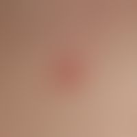 Keratosis benigne lichenoide: Reddish plaque of about 1.0 cm on the upper side of the right mamma...