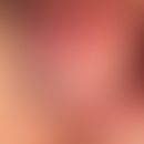 Herpes genitalis: frisches, noch intaktes Bläschen bei rezidivieredem Herpes simplex.&nbsp;
