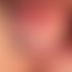 Herpes genitalis: frisches, noch intaktes Bläschen bei rezidivieredem Herpes simplex.&nbsp;
