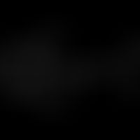 Structural formula of lidocaine
