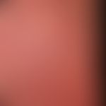 Pustulose, akute generalisierte exanthematische: akut aufgetretenes erythrodermisches Exanthem mi...