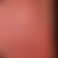 Pustulose, akute generalisierte exanthematische: akut aufgetretenes erythrodermisches Exanthem mi...