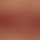 Cheilitis glandularis purulenta superficialis: schwere, akut aufgetretene&nbsp; purulente Cheilit...