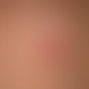 Folliculitis superficial: slightly painful follicular (staphylogenic) pyoderma with yellowish cen...