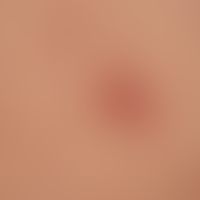 Folliculitis superficial: slightly painful, follicular (staphylogenic) pyoderma with central necr...