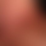 Dyskeratosis follicularis: disseminierte, chronisch stationäre, 0,1-0,2 cm große, flach elevierte...