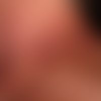 Dyskeratosis follicularis: disseminierte, chronisch stationäre, 0,1-0,2 cm große, flach elevierte...
