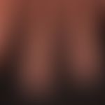 Onychodystrophie bie Dyskeratosis follicularis: Unterschiedliche Nagelveränderungen.&nbsp;
