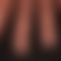 Onychodystrophie bie Dyskeratosis follicularis: Unterschiedliche Nagelveränderungen.&nbsp;
