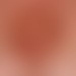 Dyskeratosis follicularis: disseminierte, chronisch stationäre, 0,1-0,2 cm große, intermamillär l...