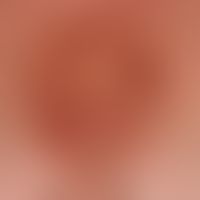 Dyskeratosis follicularis: disseminated, chronically stationary, 0.1-0.2 cm in size, intermamilla...