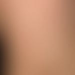 Molluscum contagiosa: buntes Bild mit multiplen, 0,2-0,3 cm großen, gelblichen, festen, glänzende...