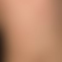 Molluscum contagiosa: colourful picture with multiple, 0.2-0.3 cm large, yellowish, firm, shiny, ...