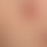 Molluscum contagiosa:&nbsp; Mollusken in unterschiedlicher Entwicklungsphase. Kleine glänzende, f...