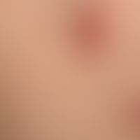 Molluscum contagiosa: Molluscs in different stages of development; small, shiny, freshly formed p...