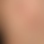 Molluscum contagiosa: buntes Bild mit multiplen, 0,2-0,3 cm großen, gelblichen, festen, glänzende...