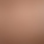 Porokeratosis superficialis disseminata actinica: Disseminated, brownish-yellowish, markedly anul...