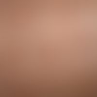 Porokeratosis superficialis disseminata actinica: Disseminated, brownish-yellowish, markedly anul...
