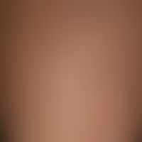 Porokeratosis superficialis disseminata actinica: disseminated, brownish-yellowish, sharply defin...