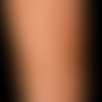 Chronischer Sonnenschaden der Haut: trockene, etwas atrophische&nbsp;Haut mit solaren Lentigines,...