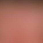 Lichtalterung der Haut: scheckige Haut mit kleinherdigen Hyperpigmentierungen (solaren Lentigines...