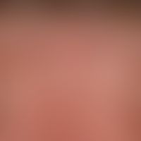 Lichtalterung der Haut: scheckige Haut mit kleinherdigen Hyperpigmentierungen (solaren Lentigines...