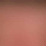 Lentigo solaris: multiple, disseminated, a few millimetres to 0.5 centimetres in size, usually bi...