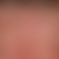 Lentigo solaris: multiple, disseminated, a few millimetres to 0.5 centimetres in size, usually bi...