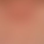 Solar lentignes: multiple, sharply defined stains of varying intensity in the area of the décolle...