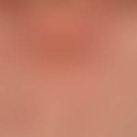 Solar lentignes: multiple, sharply defined stains of varying intensity in the area of the décolle...