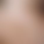 Lentigo solaris: brown, sharply bordered, smooth spot in the area of exposed skin areas (Lentigo ...