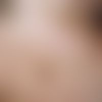 Lentigo solaris: brauner, scharf begrenzter, glatter Fleck im Bereich belichteter Hautpartien (Le...