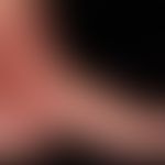 Vaskulitis leukozytoklastische (non-IgA-assoziierte): multiple, seit etwa 10 Tagen bestehende, an...