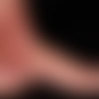 Vaskulitis leukozytoklastische (non-IgA-assoziierte): multiple, seit etwa 10 Tagen bestehende, an...