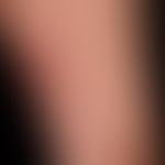 Vaskulitis leukozytoklastische (non-IgA-assoziierte): multiple, seit 1 Woche bestehende, an beide...