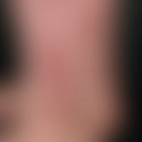 Purpura thrombozytopenische: strichförmige (nach Kratzen, sowie nach Anlegen eines Kompressionsve...