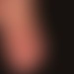 Chronic lymphoedema with positive Stemmer's sign. Massive indurative swelling of the back of the ...