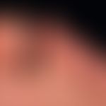 Dyshidrotische Dermatitis: chronisch rezidivierende, dyshidrotische&nbsp;Dermatitis an Händen und...