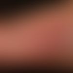 Dyshidrotische Dermatitis:&nbsp;chronisch rezidivierendes gering infiltrierte, scharf begrenzte r...